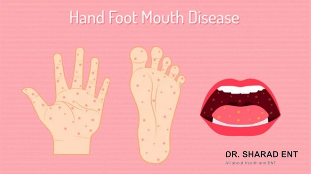 What is Hand, Foot, and Mouth Disease (HFMD)? | DR. Sharad ENT
