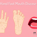 写真: What is Hand, Foot, and Mouth Disease (HFMD)? | DR. Sharad ENT