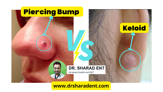piercing bump vs keloid