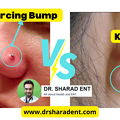 写真: piercing bump vs keloid