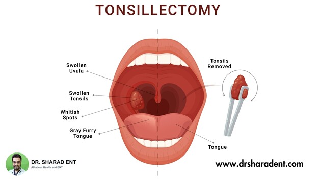 What To Expect After A Tonsillectomy Surgery