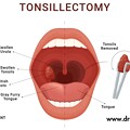 写真: What To Expect After A Tonsillectomy Surgery